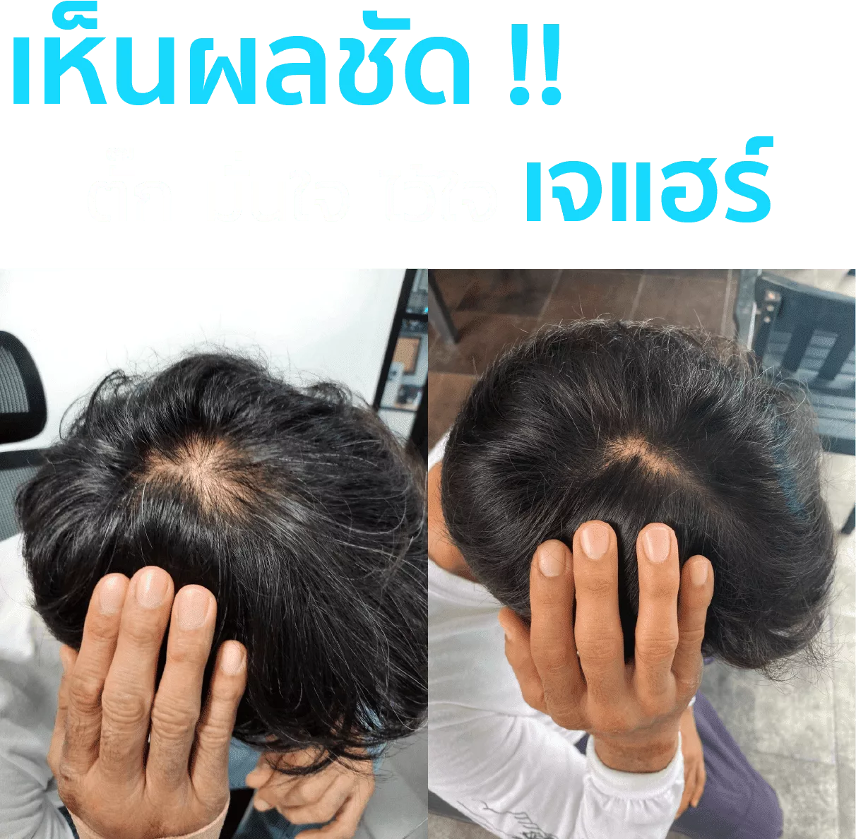 J HAIR Serum รีวิว จากคุณตั๊ก นภัสรัญชน์ มิตรธีรโรจน์